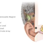 817288-014-TICI-Anatomy-MKT-v002-1